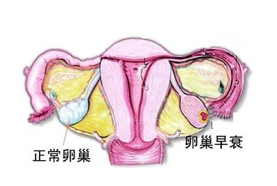 常见卵巢早衰的症状都有哪些